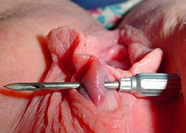 Pricking of clitoris