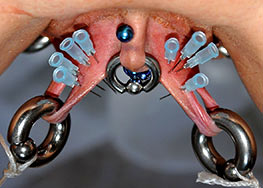 Needles in labia